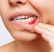 swollen gums possible causes and