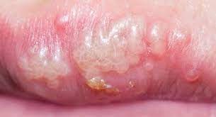 mucous cyst causes symptoms and