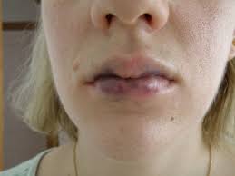 bruises on lips after restylane