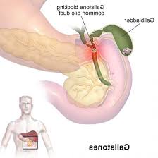 Gallstones Can Cause Sudden Pain In The Upper Right Abdomen This