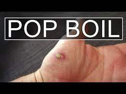 how to lance pop boil cyst you