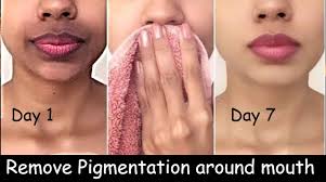 hyper pigmentation around mouth