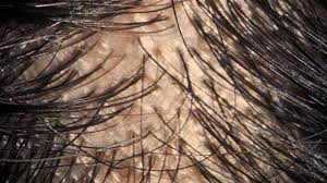 Alopecia areata is a condition where patches of hair loss develop, usually on the head. Alopecia Areata Hair Loss Causes Treatments And Tips To Cope