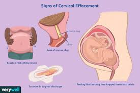 cervical effacement signs merement