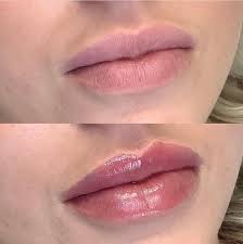 lip fillers and lip injections