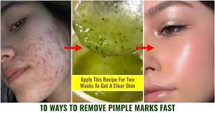 10 ways to remove black pimple marks