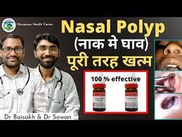 homeopathic cine for nasal polyp