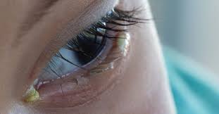 what causes crusty dry eye discharge