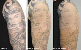 Due to all these variables, it is hard to say how many laser sessions you will need, but a laser tattoo removal consultation can usually provide you with an estimate. How Long In Between Tattoo Removal Treatments