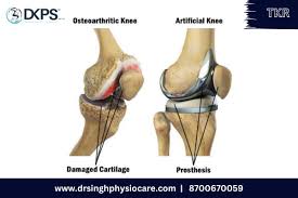 what is total knee replacement tkr