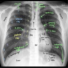 ○ the right upper lobe. Reading Chest X Rays Anatomy Labelled Reading A Grepmed