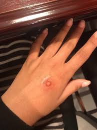 my first time creating a fake bug bite