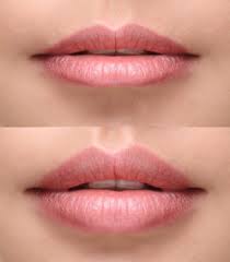 aesthetic treatments for thin lips