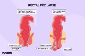 rectal prolapse symptoms causes