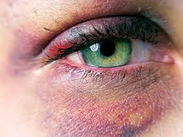 black eye causes and treatment