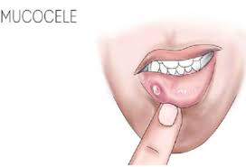 know more about mucocele the dental