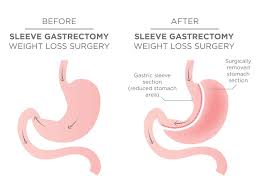 is gastric sleeve surgery the right