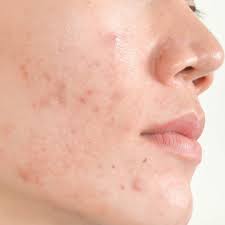 dark spots after pimples causes and