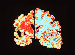 the effects of alzheimer s on the brain