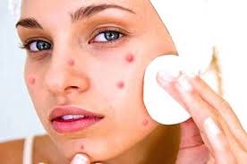 Image result for How to remove acne
