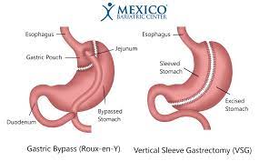gastric sleeve vs gastric byp