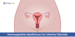 homeopathic cines for uterine fibroids