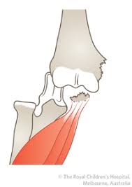 Isolated fractures can occur secondary to direct trauma indications for operative treatment include: Clinical Practice Guidelines Medial Epicondyle Fracture Of The Humerus Emergency Department