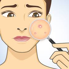 acne and skin pigmentation spots