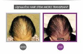 stem cell treatment for hair loss