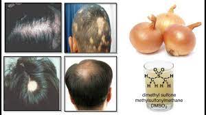 onion juice cure hair loss and promote