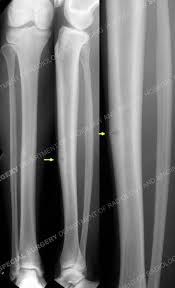 stress fractures orthopedic trauma