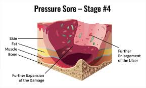 pressure sores after spinal cord injury