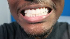 In fact, the bleaching factor of your whitening product will cause the same whitening effect as when you use it properly. Do Crest Whitestrips Work On Yellow Teeth Or Surface Stains