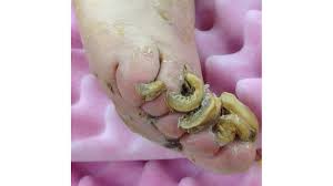 toenails that grow upward causes and