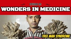 Given a chance to visit dede in hospital the producer asks how he's keeping up. Wonders In Medicine Episode 5 Tree Man Syndrome Epidermodysplasia Verruciformis Youtube