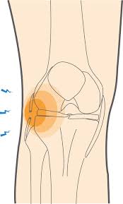 lateral collateral ligament lcl tears