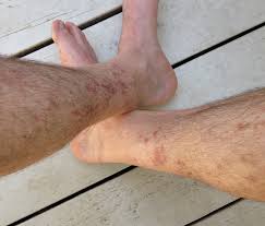 red rash between knee and ankle after