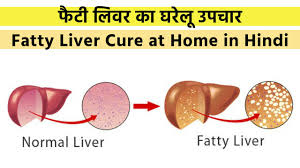 78 Unexpected Fatty Liver Diet Chart Indian