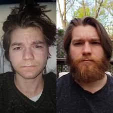 Before and after photos from real minoxidil products user: Minoxidil Beard Reddit Before And After Pictures