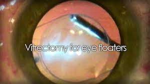 eye floaters with vitrectomy eye surgery