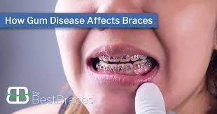 how gum disease affects braces the