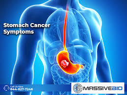 What are the most common symptoms of stomach cancer? Stomach Cancer Symptoms Gastric Cancer Informations Massive Bio