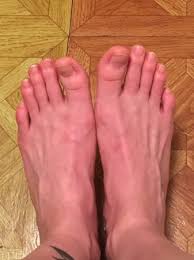 red purple feet but no swelling