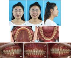 orthodontic treatment of an cl