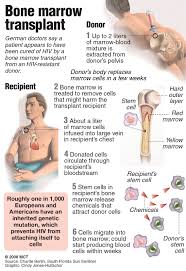 Image result for hiv cured bone marrow transplant