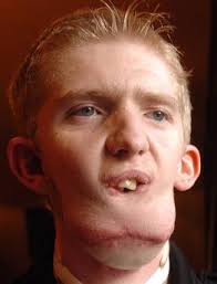 The family of Donegal teenager Alan Doherty — who has undergone a lengthy series of painful operations in America to give him a new chin at a cost of over ... - alan_28413a