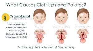 what causes cleft lips and palates