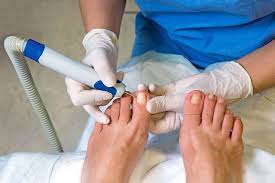 ingrown toenails treatment and prevention