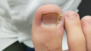 how to treat an ingrown toenail explained