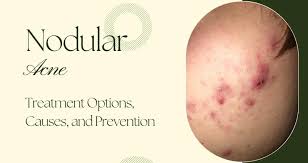 nodular acne and treatment options
